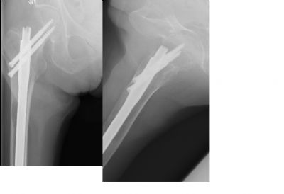 Howmedica Recon Nail (Implant 59)